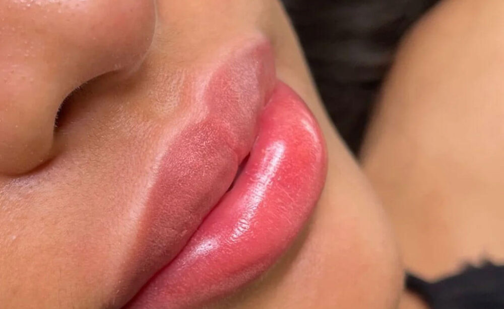 Lips Neutralization