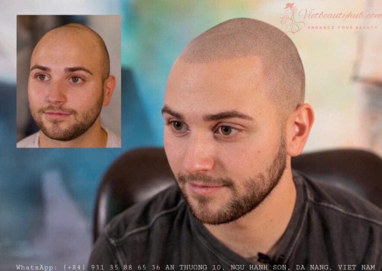 Micropigmentation du cuir chevelu pour hommes | SMP