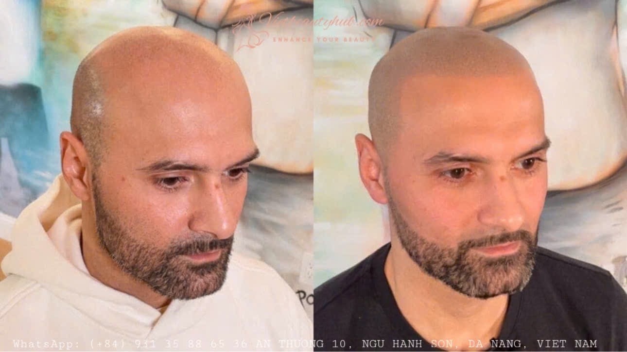 Scalp Micropigmentation in Hanoi for Men